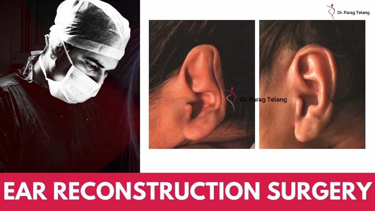 Cure Ear Deformities with Ear Reconstruction Surgery!