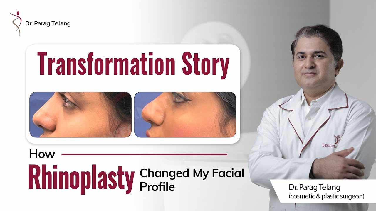 Patient Testimonial about Rhinoplasty | Best Plastic Surgeon in Mumbai