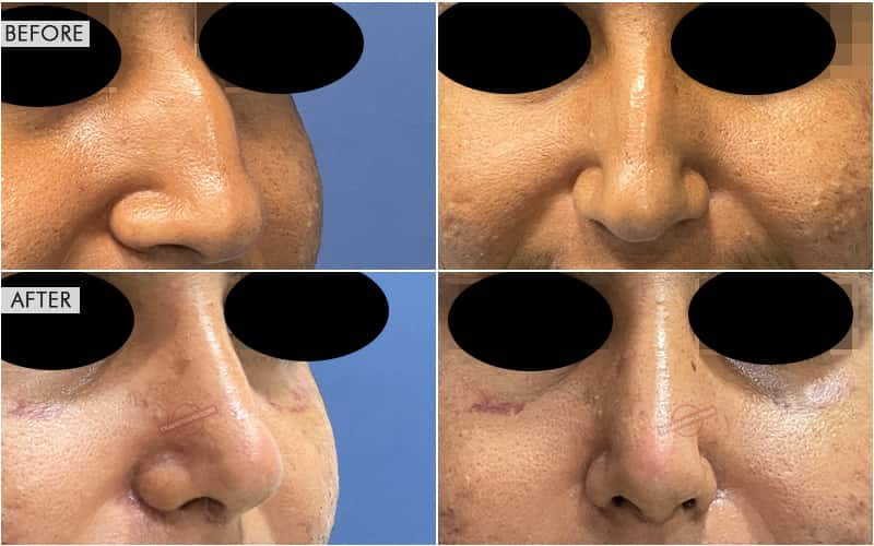 Rhinoplasty Surgery