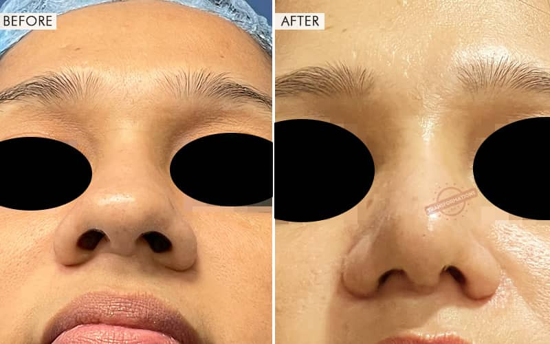 Rhinoplasty Surgery