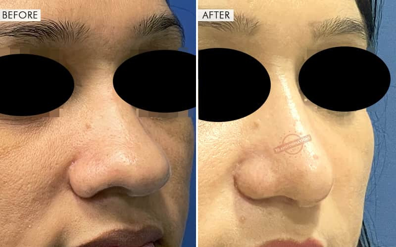 Rhinoplasty Surgery