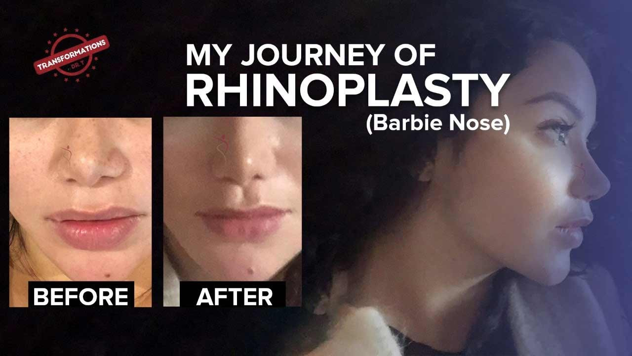 Rhinoplasty Surgery for Barbie Nose