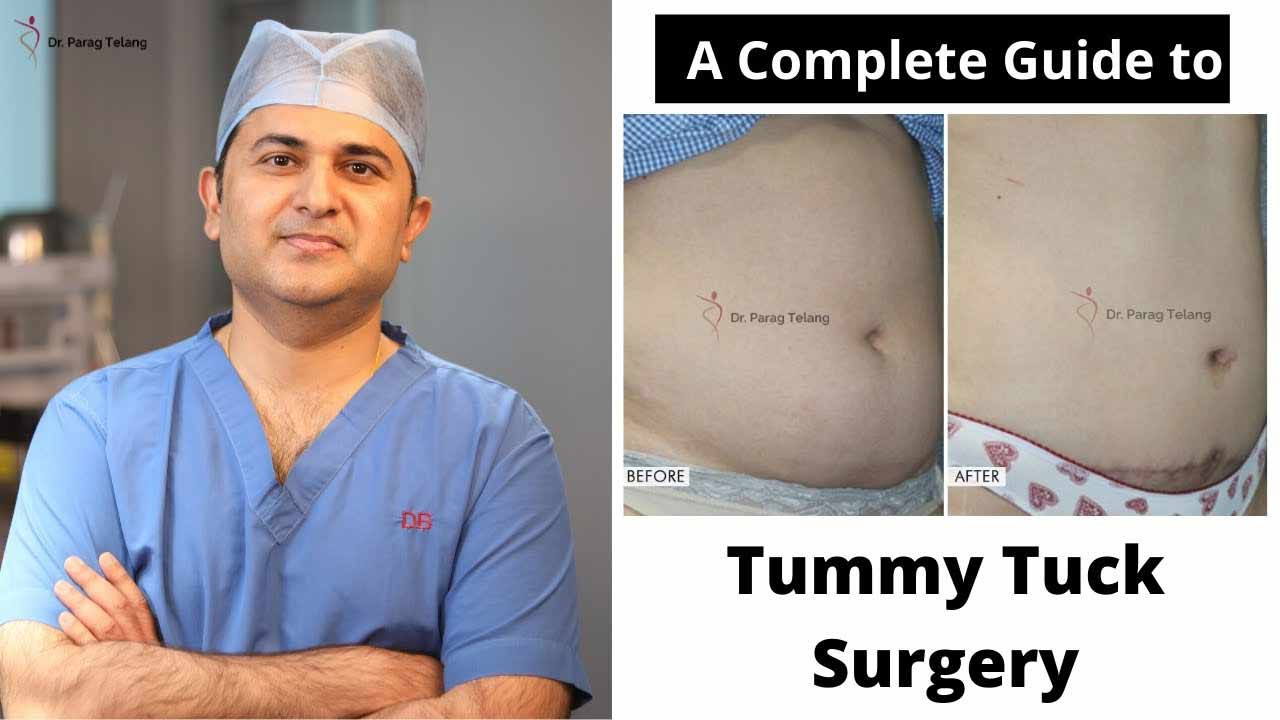 Tummy Tuck Surgery Explained - Everything You Need to Know About Abdom