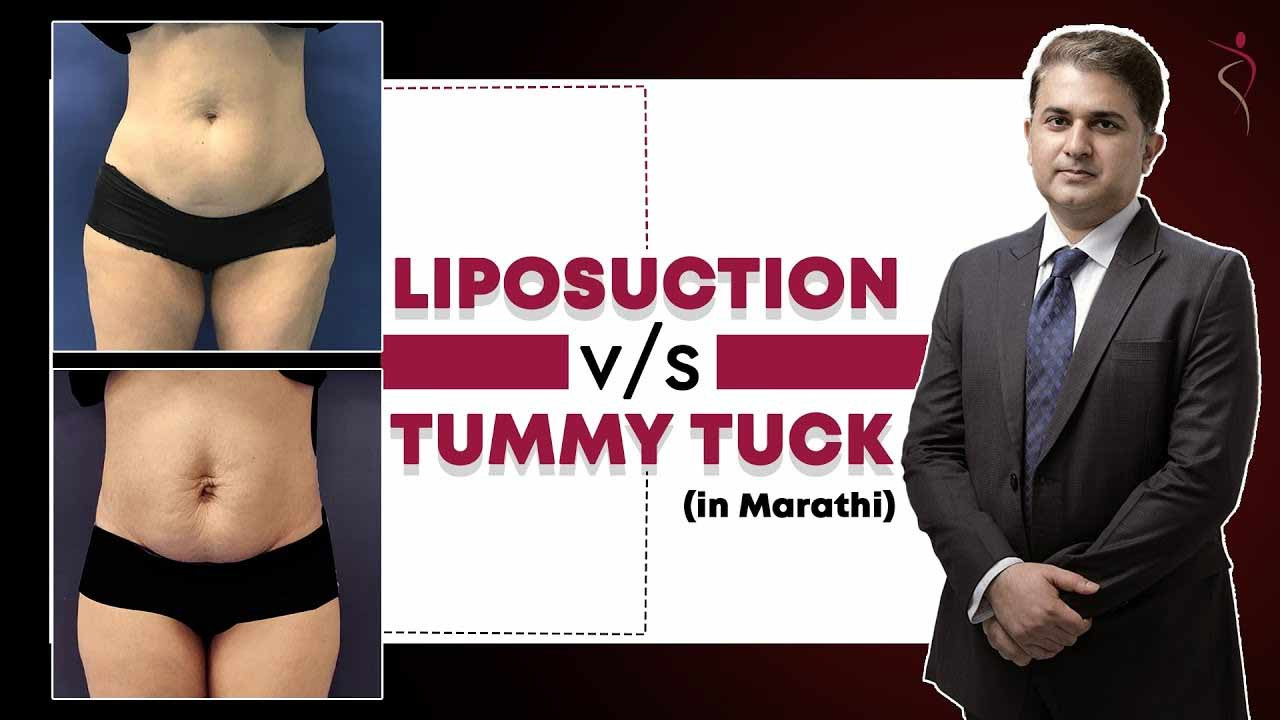 Liposuction vs Tummy Tuck: Which Is Right for You?