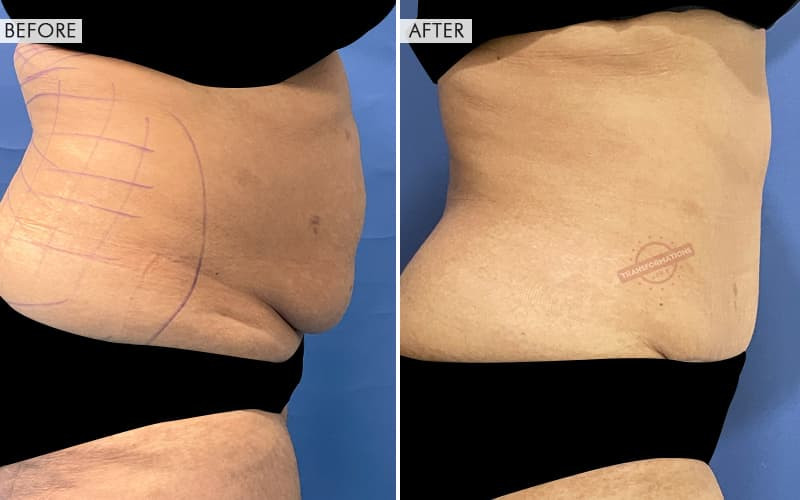 Tummy Tuck