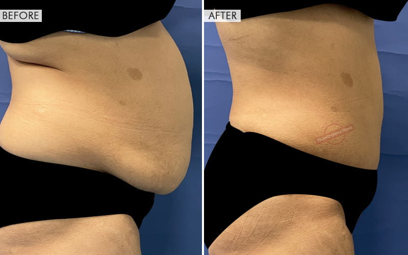 Tummy Tuck