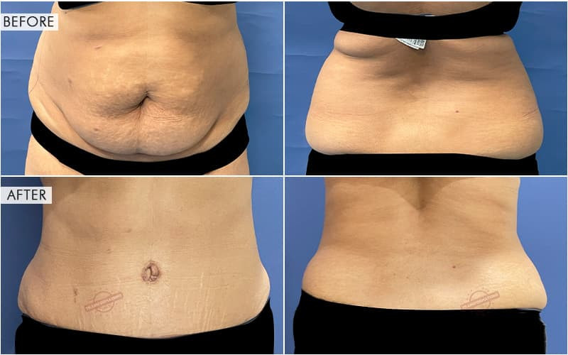 Tummy Tuck