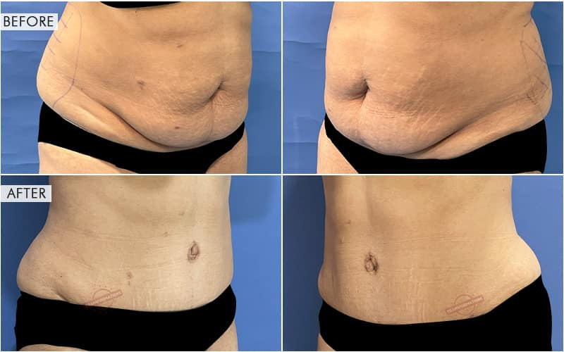 Tummy Tuck