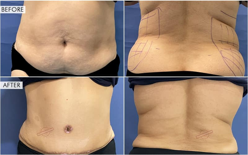 Tummy Tuck