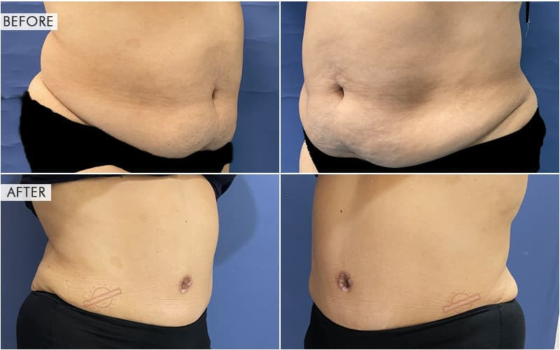 Tummy Tuck