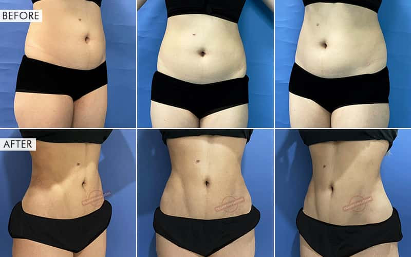 Vaser Liposuction