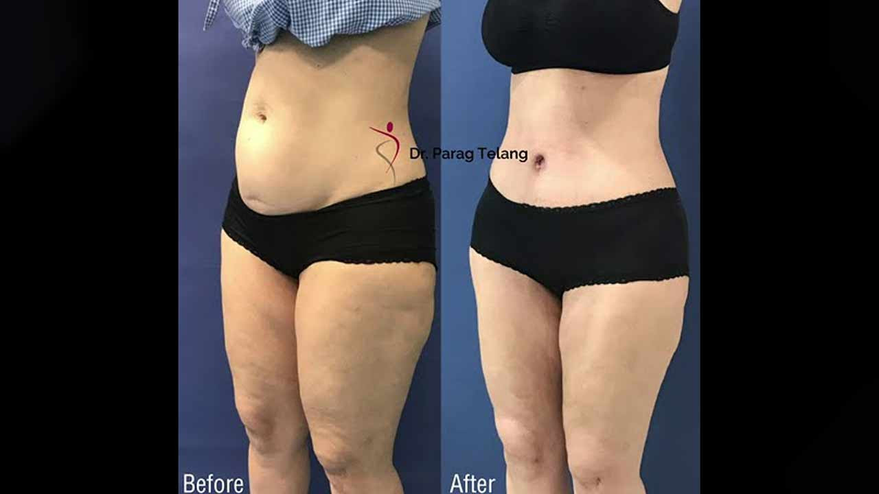 Body Transformation with Tummy Tuck and Vaser Liposuction