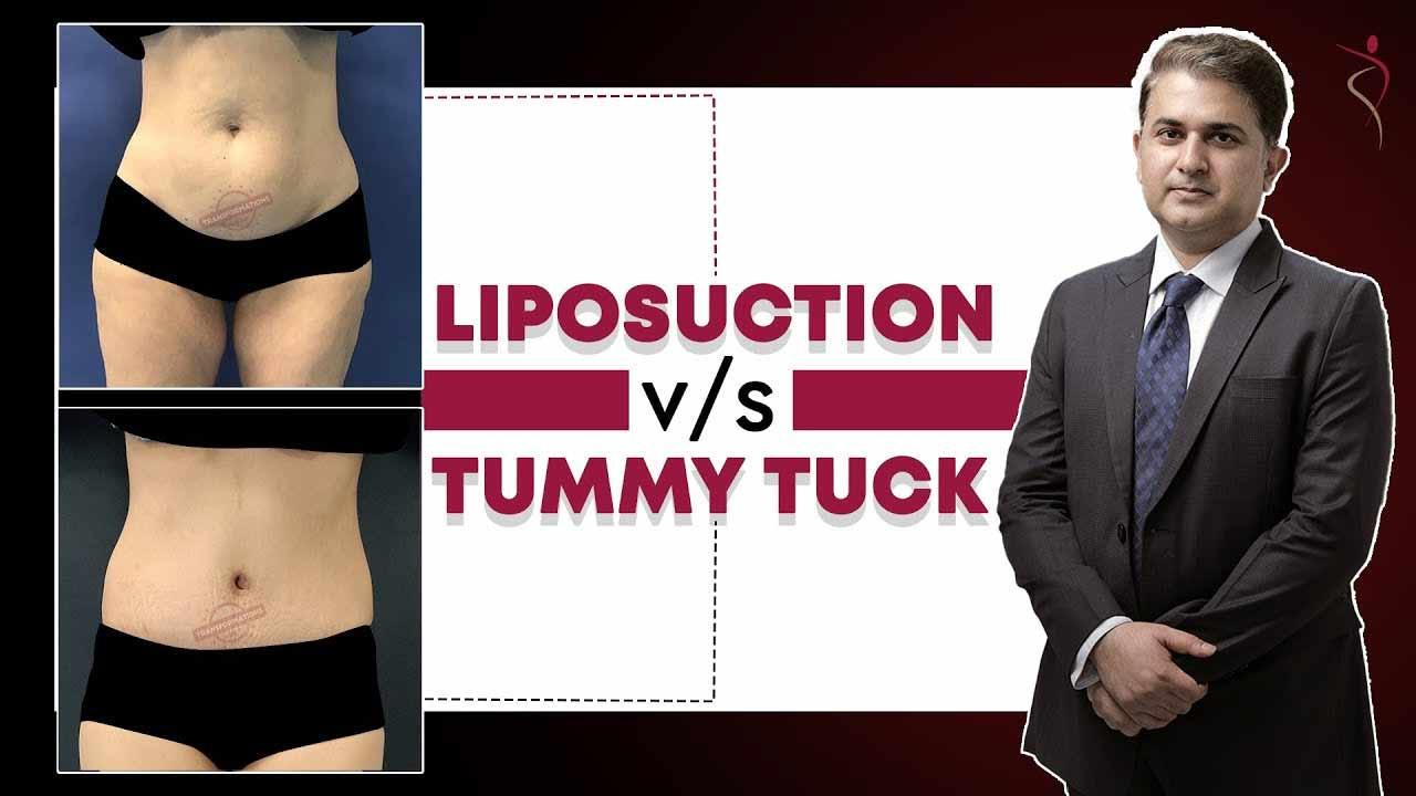 Liposuction or Tummy Tuck