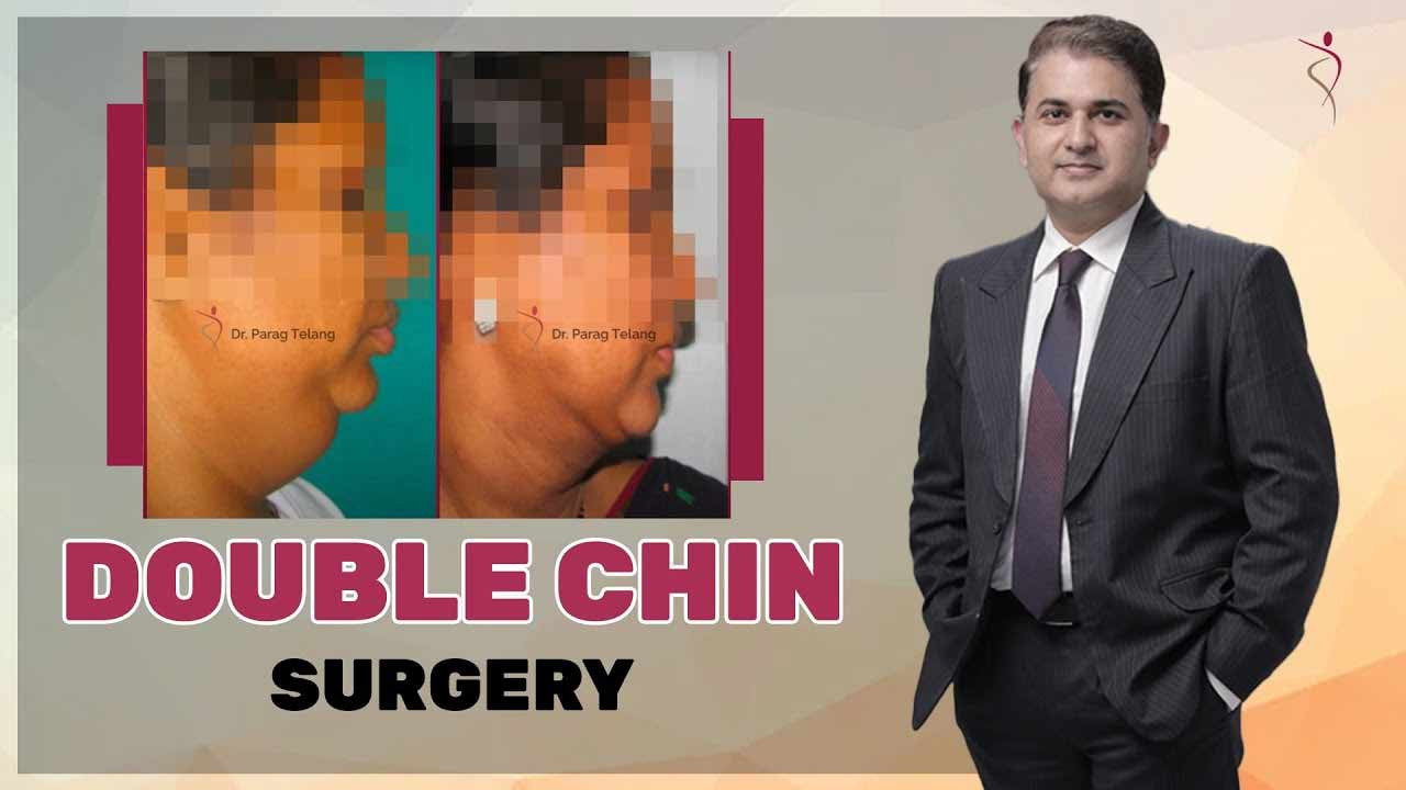 Double Chin Removal Surgery