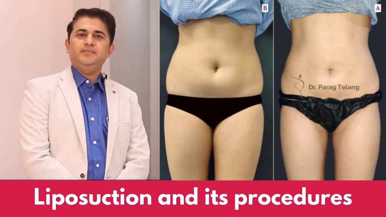 Know everything about Liposuction and its procedures
