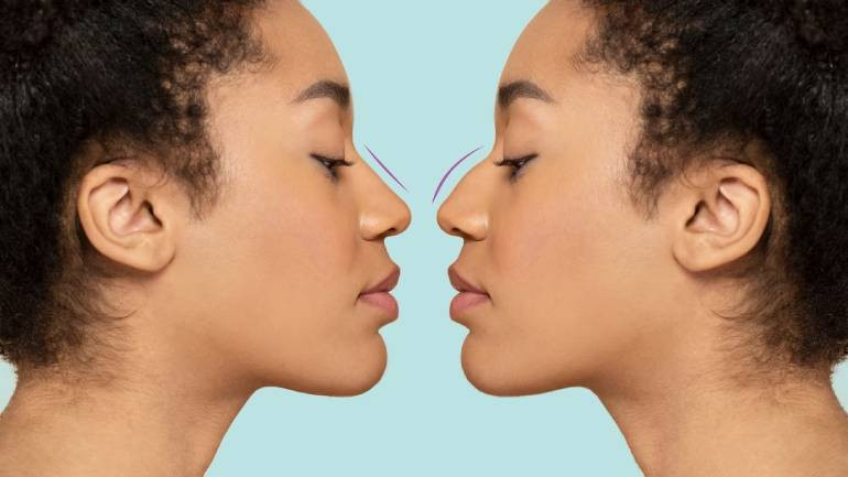 Ethnic Rhinoplasty: Enhancing Beauty, Preserving Identity