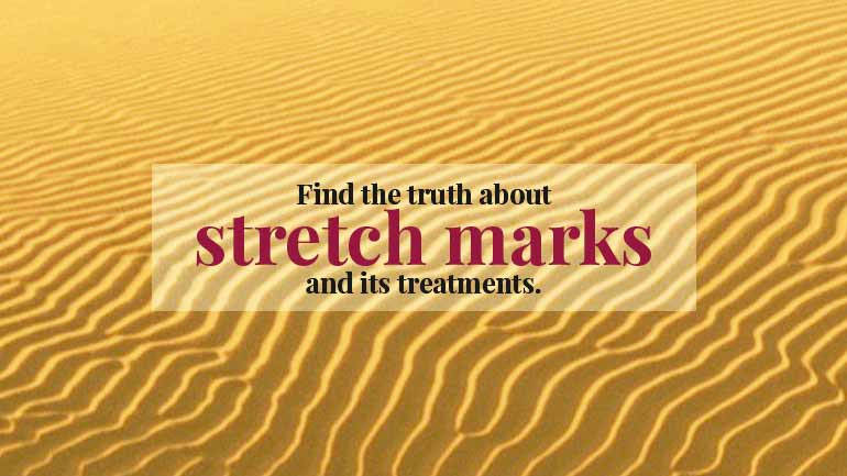 Find the Truth About Stretch Marks And its Treatments