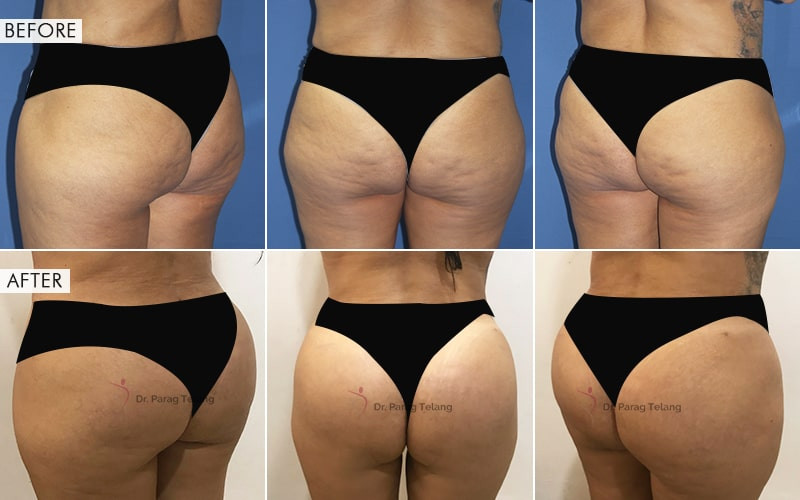 Results  Butt Augmentation Before and After