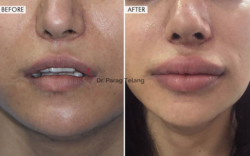 Lip Augmentation