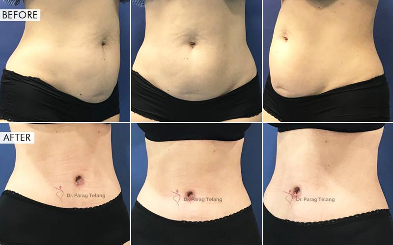 Tummy Tuck