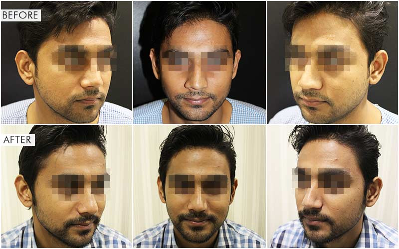جراحة تجميل الأنف قبل وبعد
