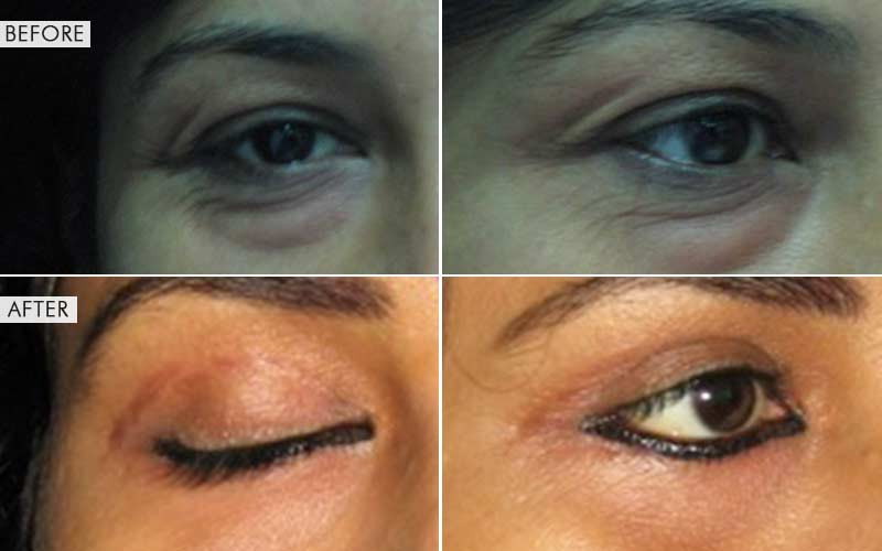 Blepharoplasty surgery