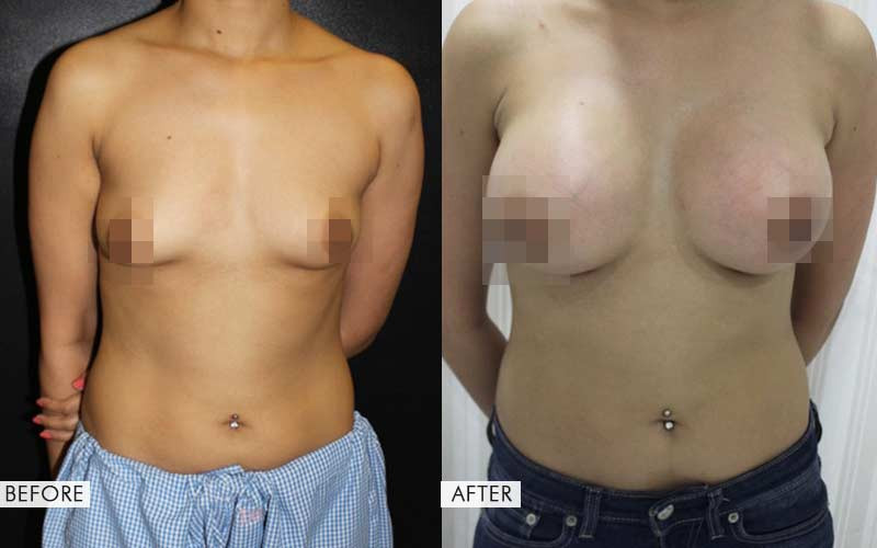 Breast Augmentation Surgery